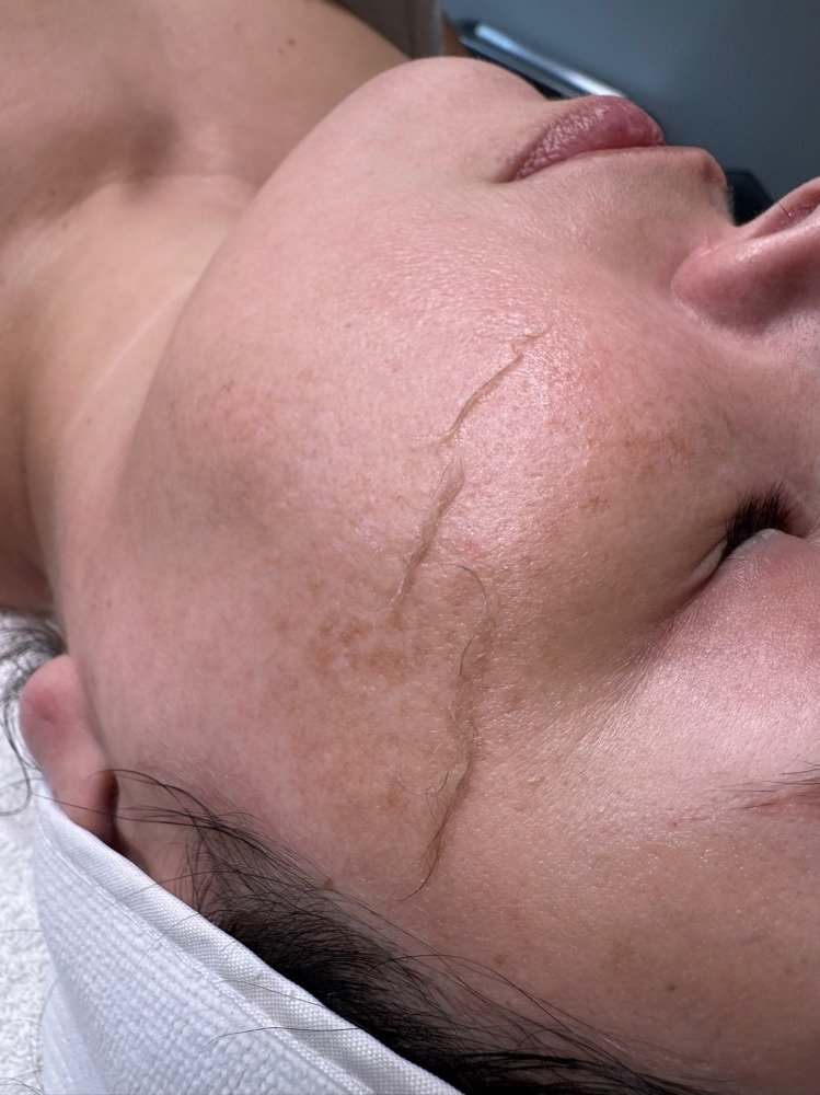 Dermaplaning Facial treatment
